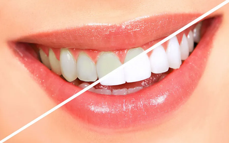 Clareamento Dental